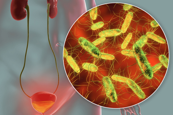 Infecciones Urinarias Recurrentes