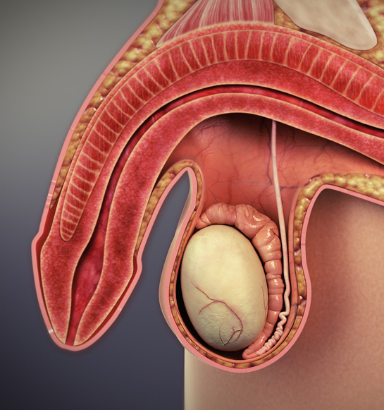 Disfunción Eréctil