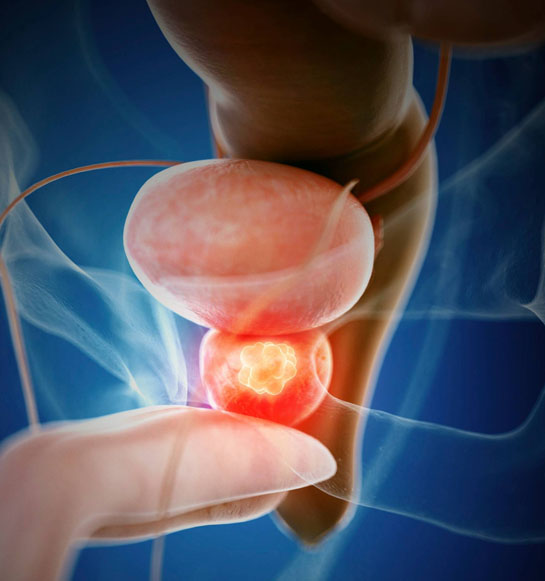 Urología Oncológica